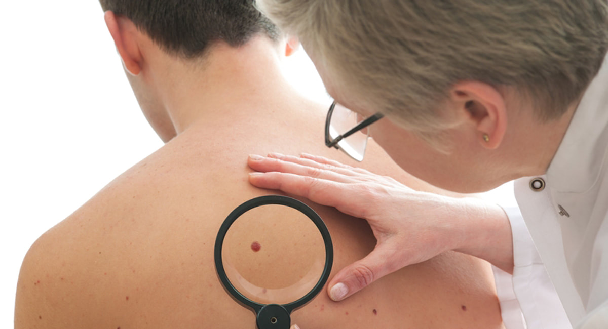 Estrogen plays a pivotal role in curbing melanoma
