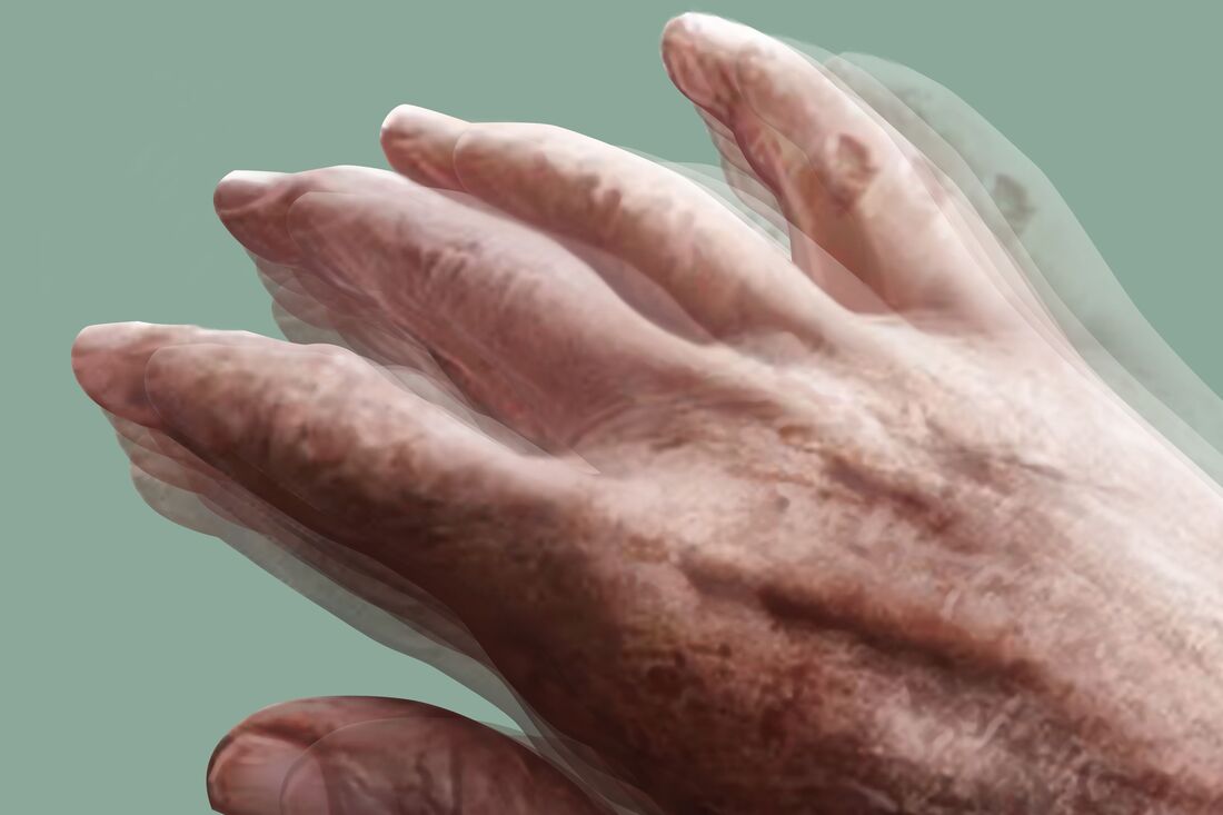 Parkinson’s disease is common among males but causes faster deterioration in females