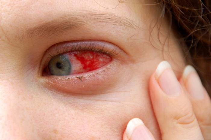 Eyesight is rarely affected in Pink Eye conjunctivitis