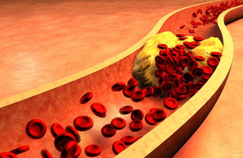 Plaque buildup causes atherosclerosis