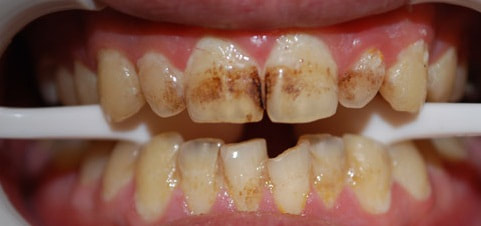 Oral hygiene plays an integral role in teeth coloration
