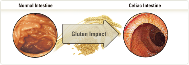 Celiac disease can occur at any stage of life