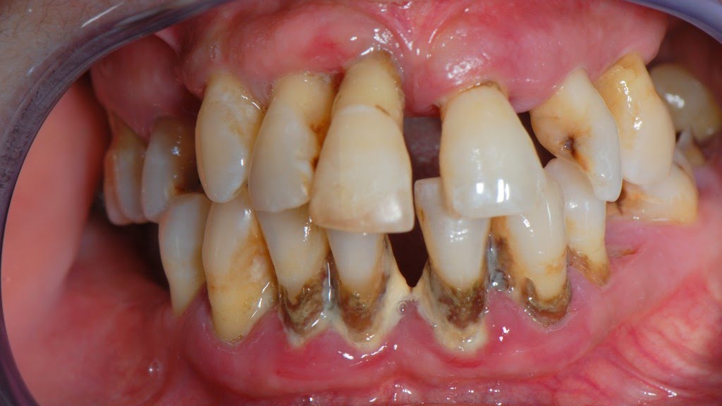 Periodontal disease paves way for pockets formation