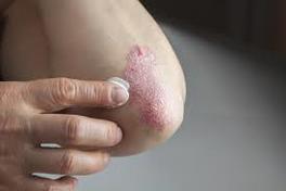 Flare ups are common in eczema patients