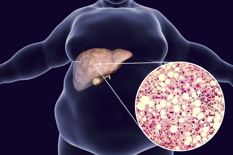 Diet modifications can reduce effects of fatty liver
