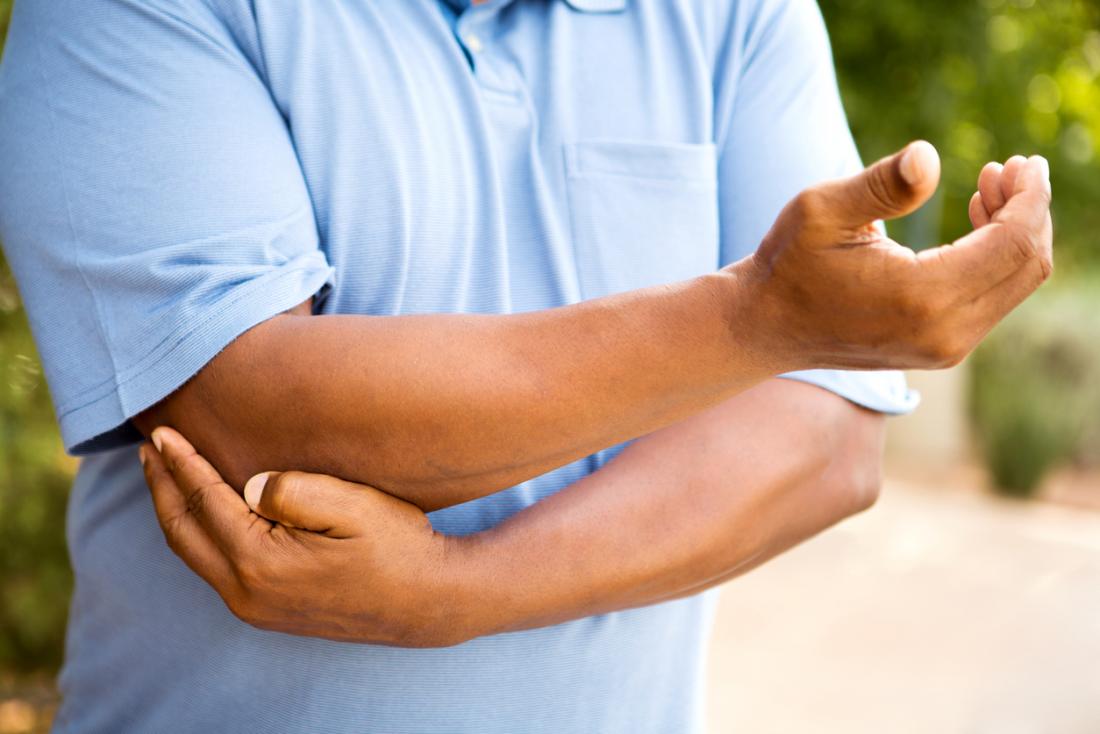 Obesity can worsen effects of rheumatoid arthritis
