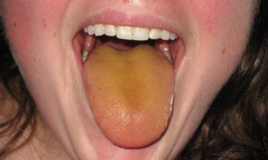 Orange tongue is not a serious ailment mostly