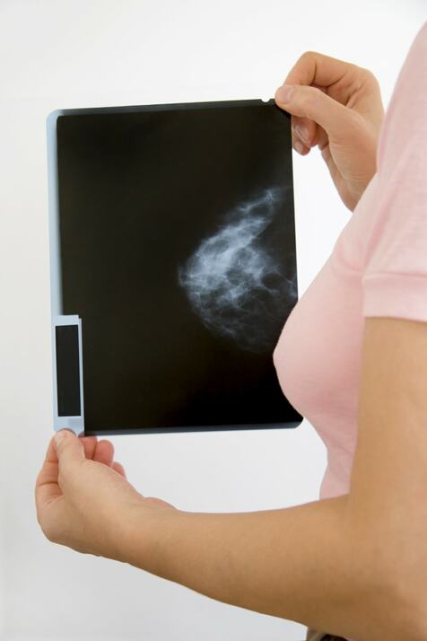 Lifestyle changes can impede Breast Cancer risk