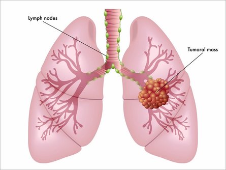 Individuals who smoke must go for lung cancer screening yearly once