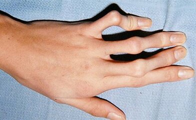 Marfan syndrome is due to a genetic mutation