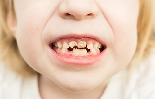 Tooth decay is very common in young kids and adolescents
