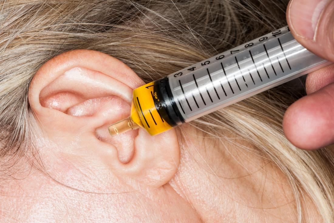 Earwax accumulation causes blocked ears