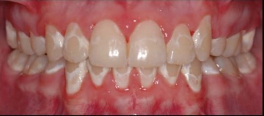 Oral hygiene is required to avoid white spots on the teeth