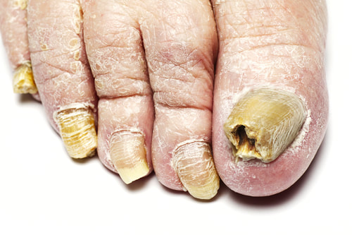 Nail hygiene prevents fungal infections